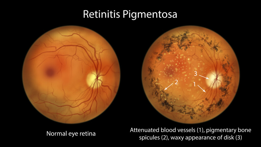 Que Es La Retinosis Pigmentaria